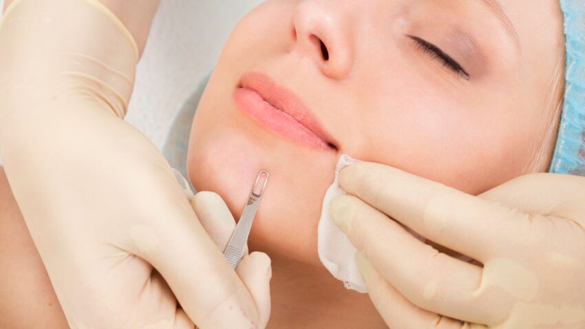 facial with extractions in Dallas, TX